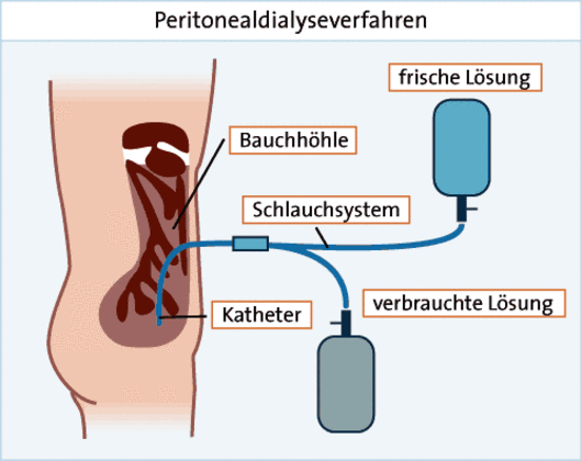 Grafik: Peritonealdialyse